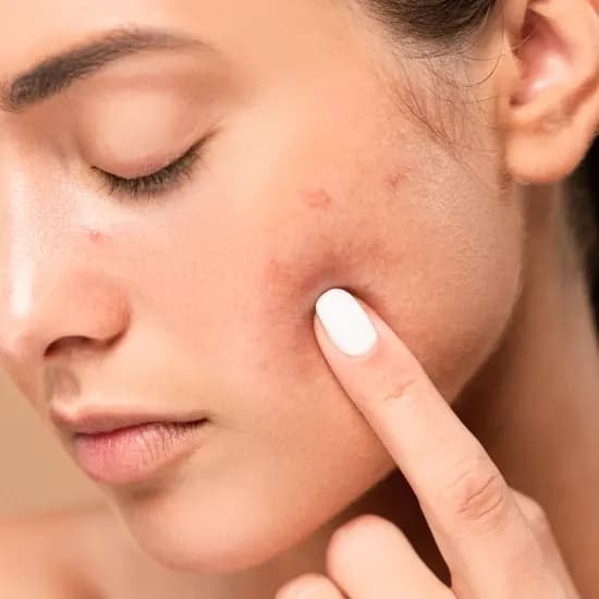 Acne Scarring